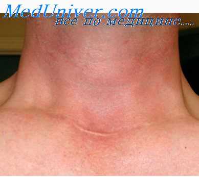 активаторы канцерогенеза