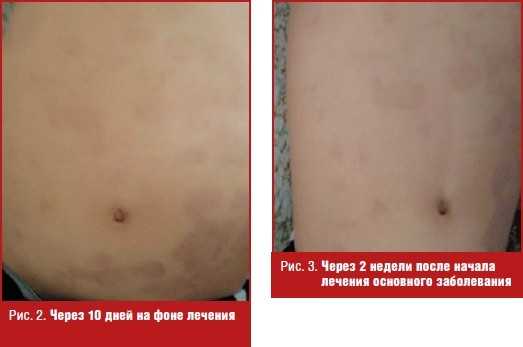 Через 10 дней на фоне лечения