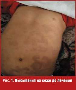 Высыпания на коже до лечения