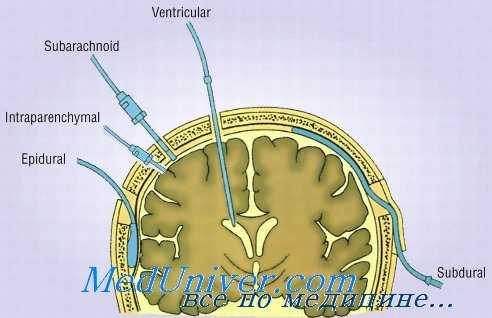 мониторинг внутричерепного давления