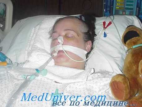 мониторинг внутричерепного давления