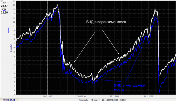 Рисунок 9. Тренды динамики ВЧД, измеряемого в паренхиме и желудочках мозга.