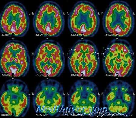 оценка местного мозгового кровотока