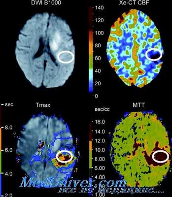 оценка местного мозгового кровотока
