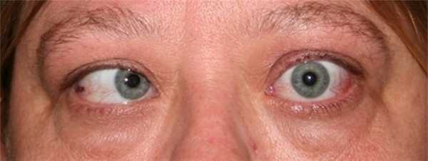 Эзотропия аккомодационная