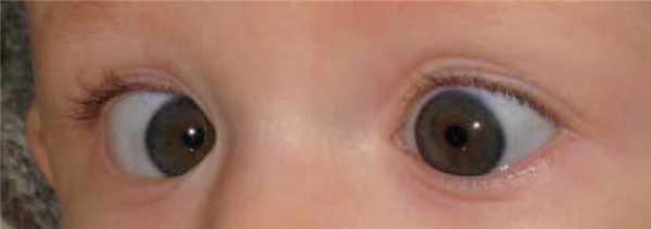 Эзотропия у ребенка