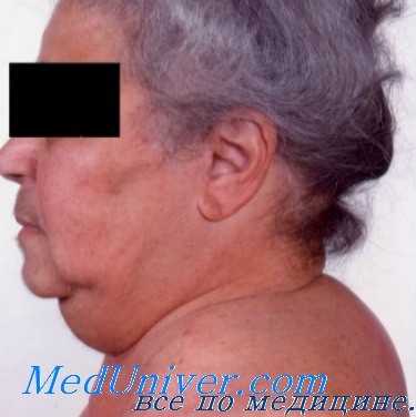 болезнь иценко-кушинга