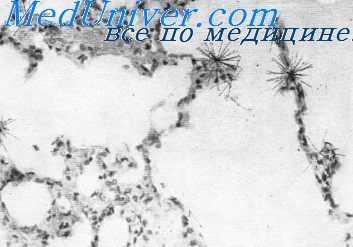 радиационное поражение кишечника