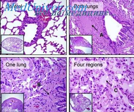 лучевая болезнь