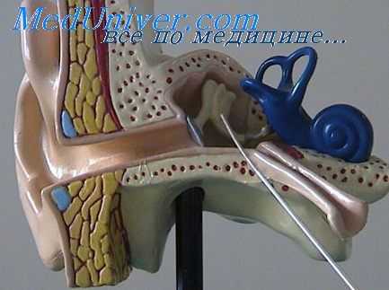 лабиринтит