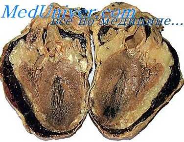 врожденный порок сердца