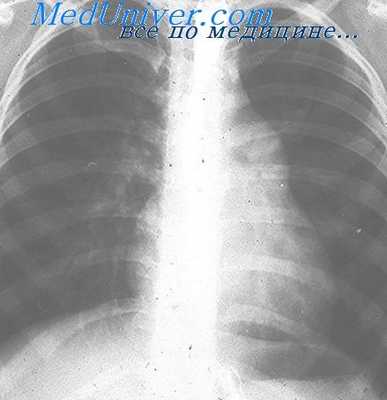 легочная гипертензия