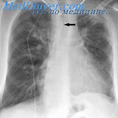 легочная гипертензия