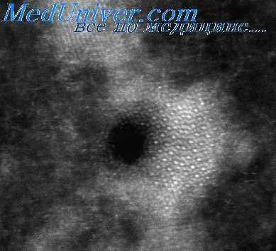 лучевое поражение печени