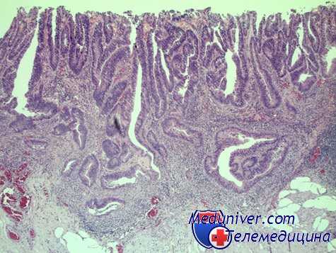 рак желудка