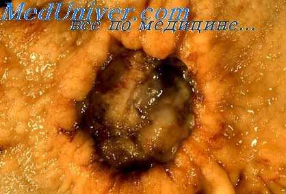 множественный рак желудка