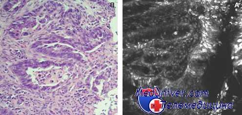 множественный рак желудка