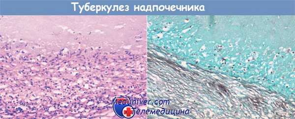 туберкулез надпочечника