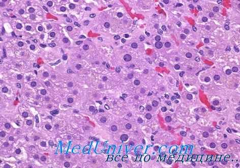 острая недостаточность коры надпочечников