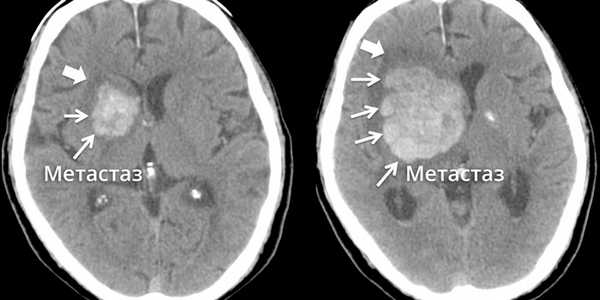 Метастаз в головном мозге в динамике