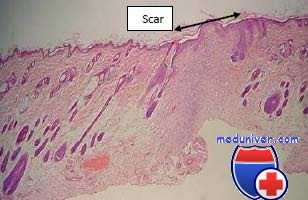 пулевая рана