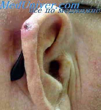 морфология рака ушной раковины