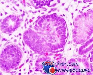 рак среднего уха