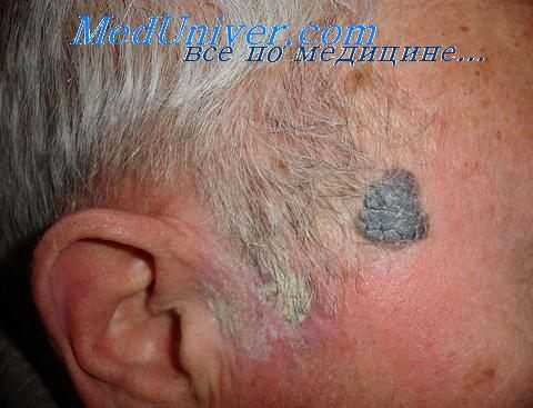 опухоль кожи