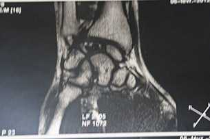 Некроз полулунной кости на МРТ