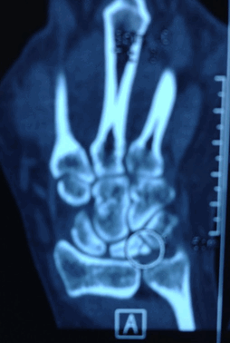 Болезнь Кинбека или Кинбока (некроз полулунной кости)