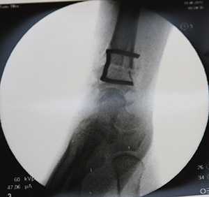 Элегантный способ фиксации остеотомии скобкой.