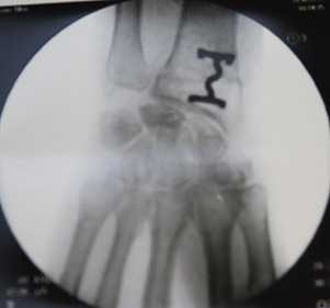 Снимок после укорочения лучевой кости