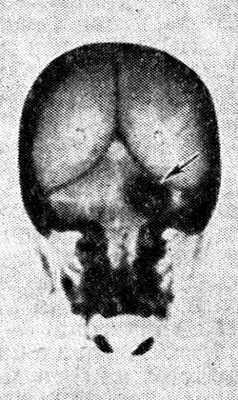 Рис. 3. Компьютерная томограмма черепа больного с невриномой слухового (преддверно-улиткового) нерва: стрелкой указана тень опухоли в области мостомозжечкового угла.