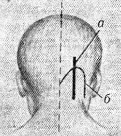 Рис. 6. Схематическое изображение доступов к мостомозжечковому углу: а — по Адсону, б — по Денди; пунктиром показана осевая линия.