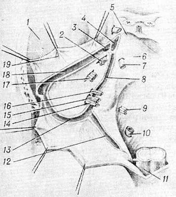 Рис. 2. Задняя поверхность пирамиды височной кости, анатомические образования мостомозжечкового угла: 1 — средняя черепная ямка, 2 — тройничный нерв, 3 — пещеристый синус, 4 — внутренняя сонная артерия, 5 —задний клиновидный отросток спинки турецкого седла, 6 — базальная поверхность, 7 — отводящий нерв, 8 — нижний каменистый синус, 9 — подъязычный нерв, 10 — позвоночная артерия. 11 — продолговатый мозг, 12 — затылочный синус, 13 — сигмовидный синус, 14 - добавочный нерв, 15 — блуждающий нерв, 16 —языкоглоточный нерв, 17 —слуховой (преддверно-улитковый) нерв, 18 — верхний каменистый синус, 19 — намет мозжечка (отвернут и взят на держалки).