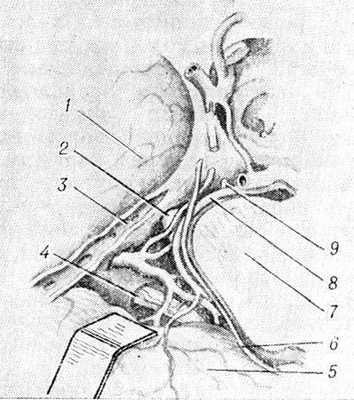 Рис. 1. Топография мостомозжечкзвого угла: 1 — тройничный узел, 2 — корешок тройничного нерва, 3 — верхний каменистый синус, 4 — лицевой нерв и слуховой (преддверно-улитковый) нерв, 5—мозжечок, 6 — блоковый нерв, 7 — ствол мозга, 8 — верхняя мозжечковая артерия, 9 — отводящий нерв.