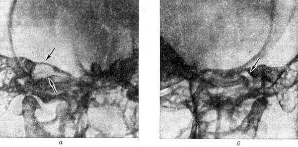 Рис. 4. Рентгенограммы по Стенверсу височных костей больного с невриномой правого слухового (преддверно-улиткового) нерва: а — виден резко расширенный правый внутренний слуховой проход (указан стрелками); б — нормальная ширина слухового прохода (указан стрелкой) левой (здоровой) височной кости.