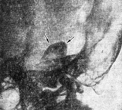 Рис. 5. Рентгенограмма по Стенверсу черепа больного менингиомой мостомозжечкового угла: стрелками указана тень обызвествленной опухоли.
