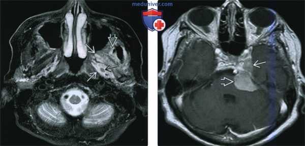 КТ, МРТ при моторной денервации нижнечелюстного нерва