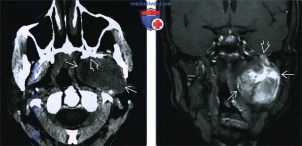 Шваннома жевательного пространства - лучевая диагностика