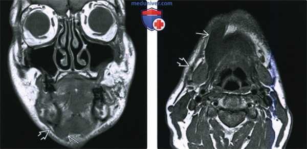 КТ, МРТ при моторной денервации нижнечелюстного нерва