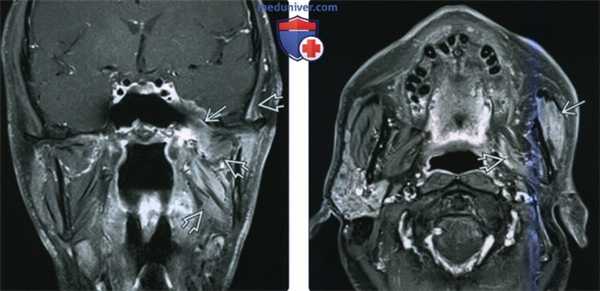 КТ, МРТ при моторной денервации нижнечелюстного нерва