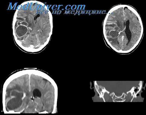 МРТ при абсцессе височной доли мозга