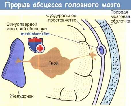 Прорыв абсцесса головного мозга