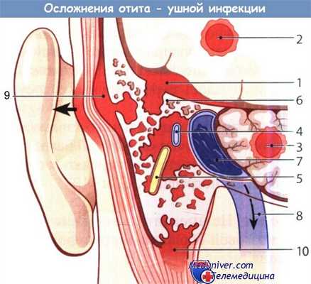 Осложнения отита и его лечение