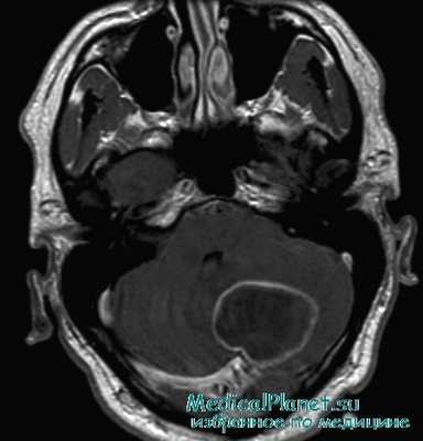МРТ при абсцессе мозжечка