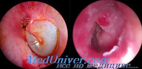 отогенные осложнения в мозге в виде абсцесса