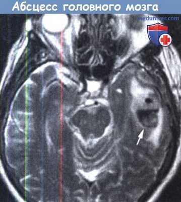 Абсцесс головного мозга