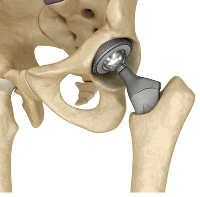 Можно ли делать МРТ с эндопротезом