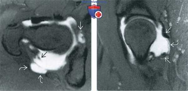 Признаки повреждения капсулярных связок тазобедренного сустава на артрограмме